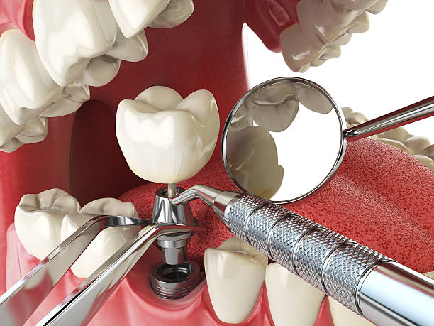 Best Emergency Dental Care for Abscessed Tooth in Ruckersville, VA
